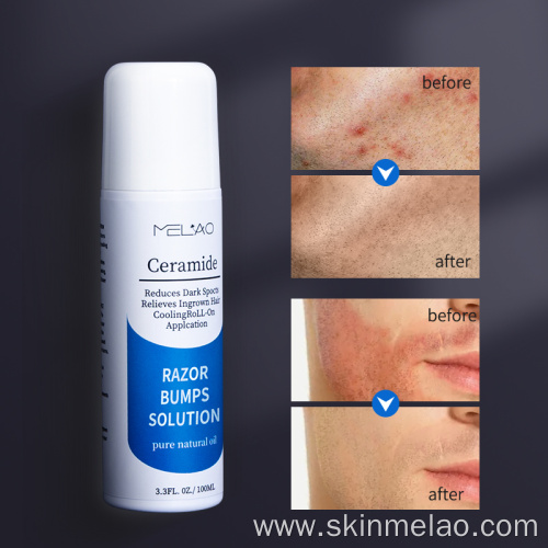 Reduces Delicate And Smooth Razor Bumps Solution